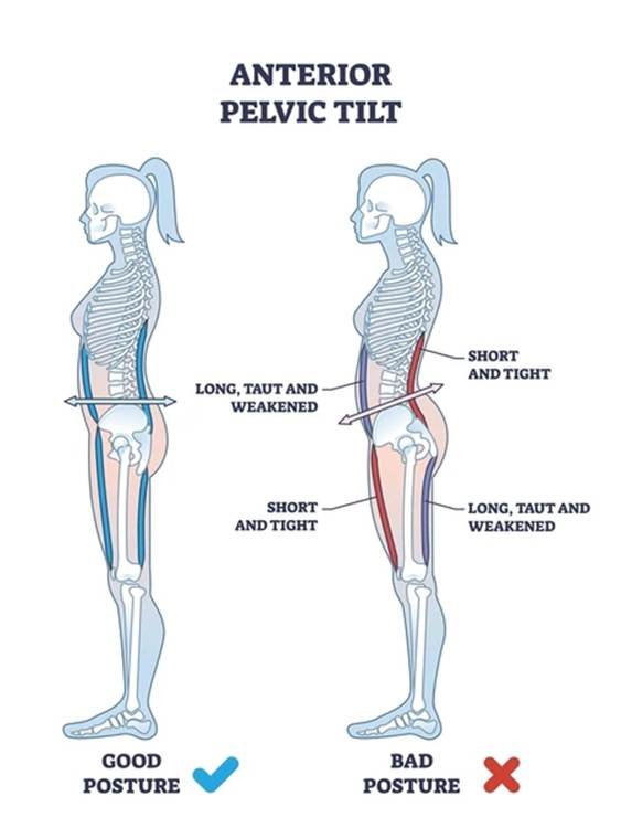 Figure showing a neutral spinal alignment and an APT spinal alignment